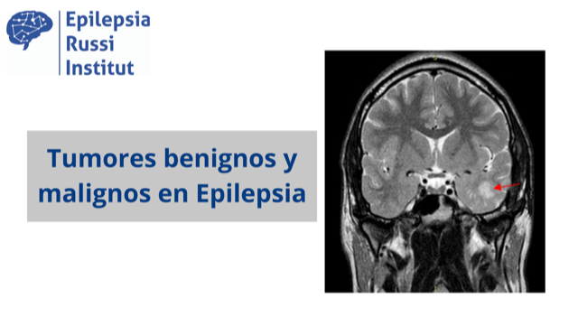 Tumores cerebrales epileptógenos
