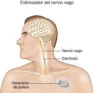 neuroestimulador del nervio vago